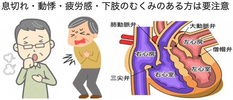 息切れ・動悸・疲労感・下肢のむくみのある方は要注意